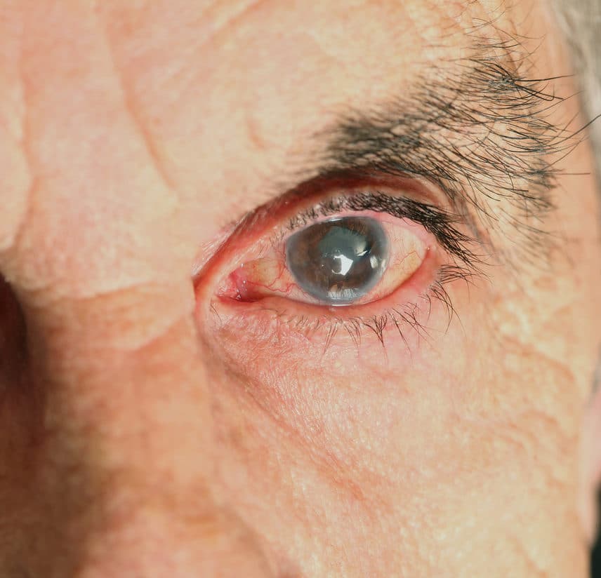 elderly man's eye with glaucoma