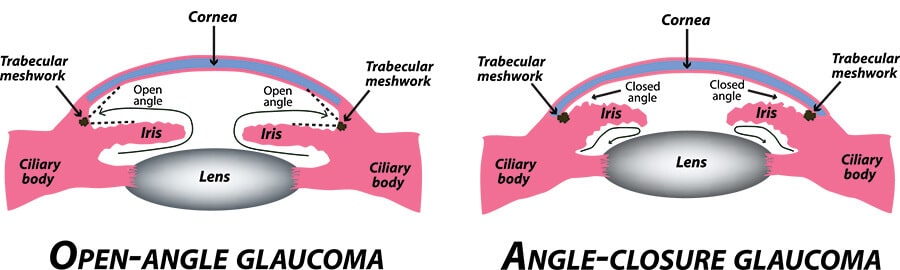 Chart Illustrating How Open-Angle Glaucoma and Angle-Closure Glaucoma Affect the Eye