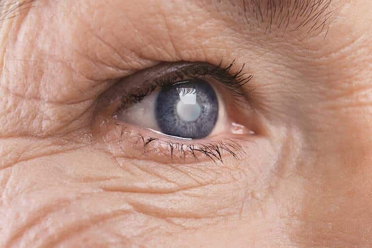 Closeup of a Cataract in an Eye