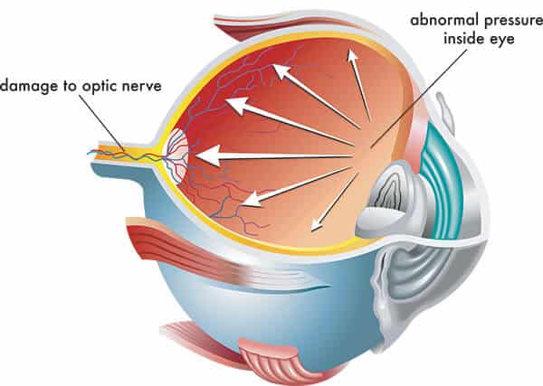 Chart Illustrating How Glaucoma Affects the Eye