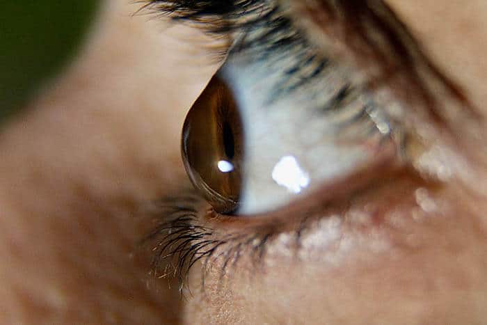 Closeup of an Eye With Keratoconus